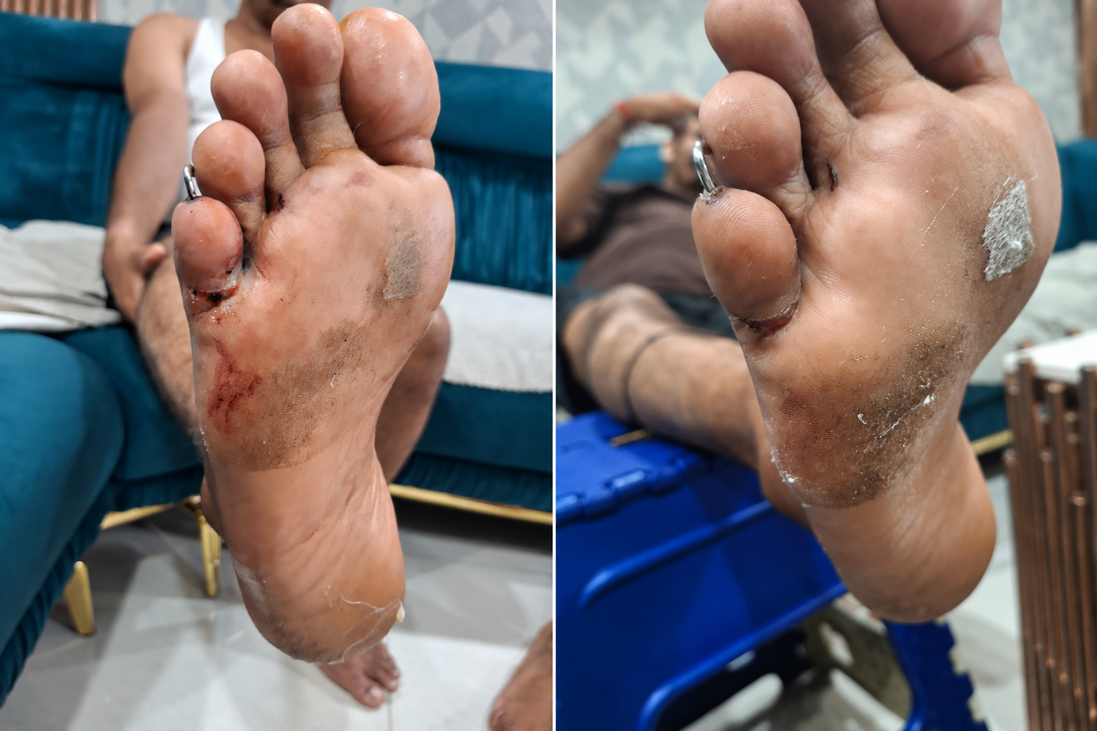 Side-by-side foot and toe injury photos documented before and after a home dressing visit