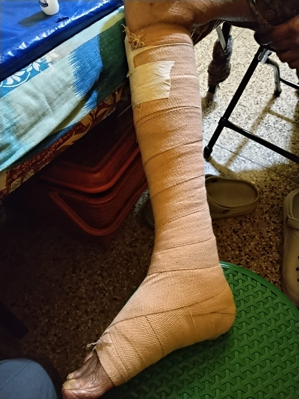 Multilayer Compression Therapy applied to lower limb